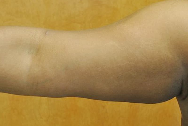 arm life 2 after