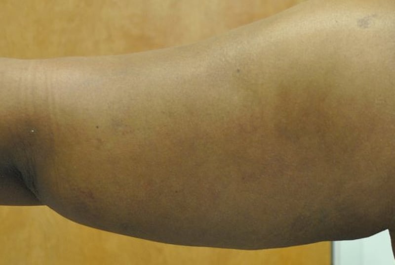 arm life 2 before