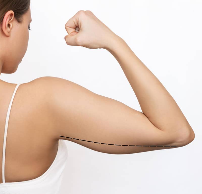 arm lift surgery