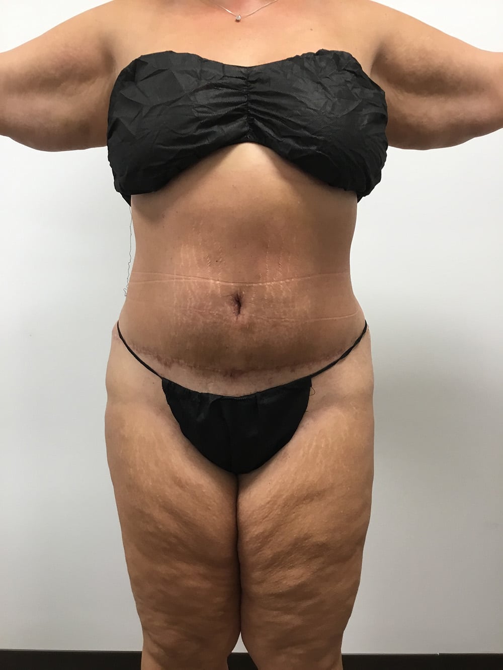 tummy tuck after 01