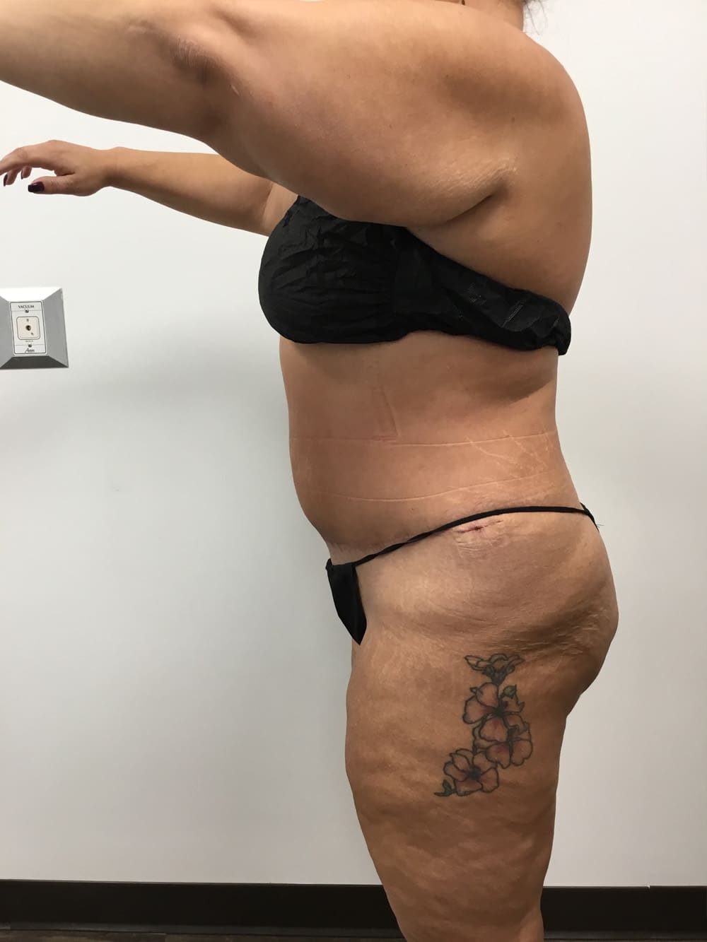 tummy tuck after 01b