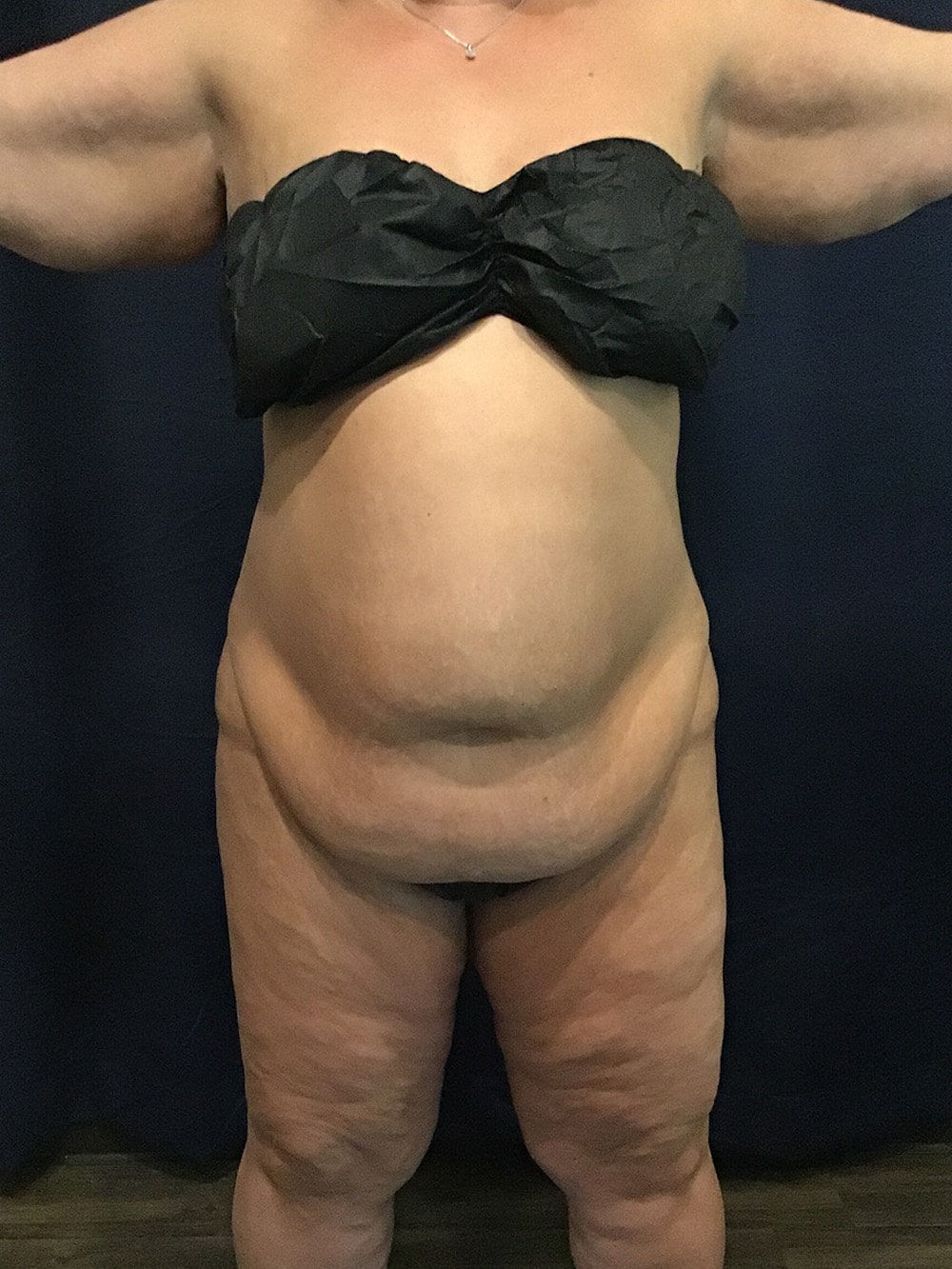 tummy tuck before 01