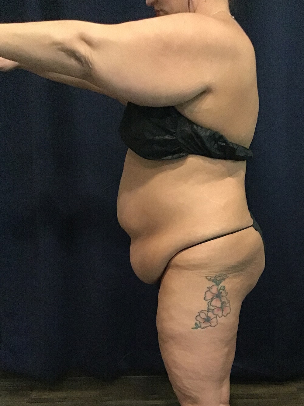 tummy tuck before 01b