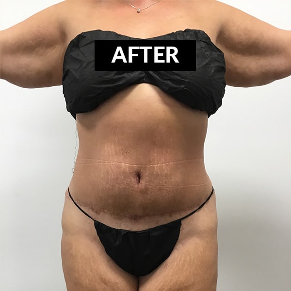 after tickletuck