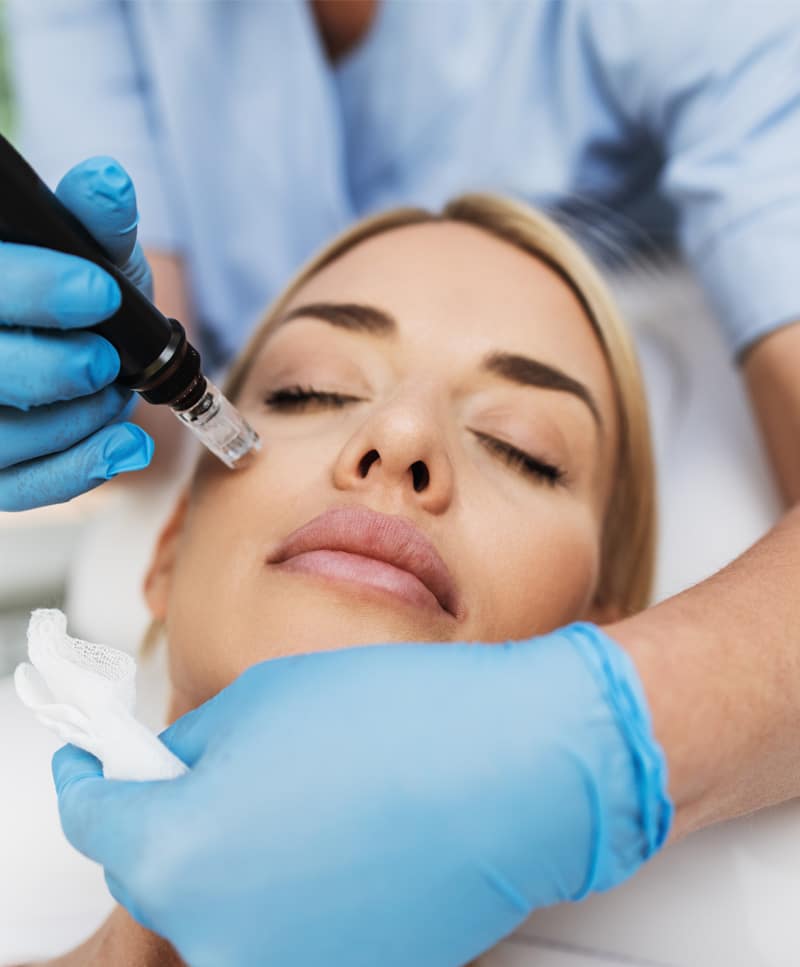 microneedling treatment img
