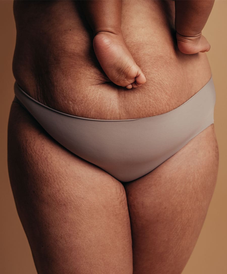 post pregnancy tummy tuck