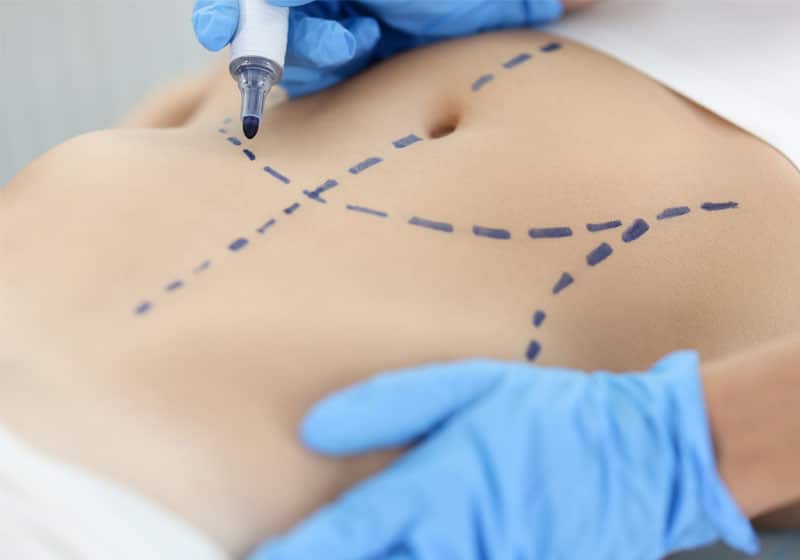tummy tuck